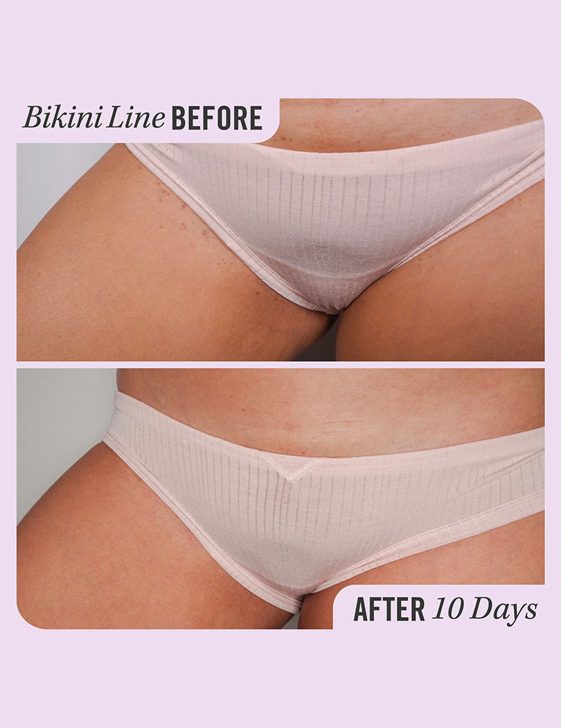 First Aid Beauty Ingrown Hair Treatment Pads, 28 pcs